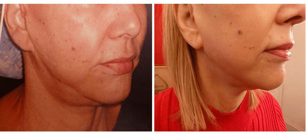 À gauche, profil de visage avant lifting cervico-facial biplan. À droite, profil de visage un an après lifting cervico-facial biplan. © Dr Mitz, tous droits réservés