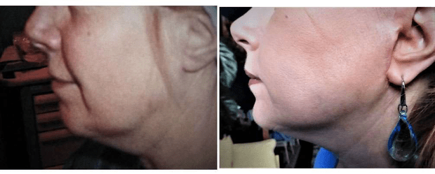 À gauche, aspect de cou empâté avant lifting CF biplan. À droite, résultat 6 mois après lifting CF biplan. © Dr Mitz, tous droits réservés