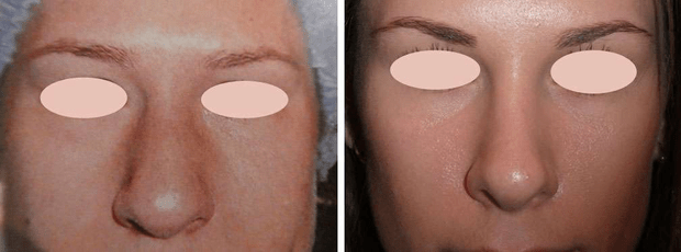 Grand nez sévère corrigé par rhinoseptoplastie, avant et après. © Dr Mitz, tous droits réservés Grand nez sévère corrigé par rhinoseptoplastie, avant et après. © Dr Mitz, tous droits réservés