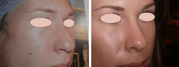 Vues de 3/4 avant et après intervention. © Dr Mitz, tous droits réservés Vues de 3/4 avant et après intervention. © Dr Mitz, tous droits réservés