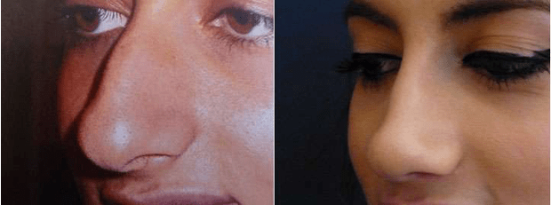 Nez large et bossu : correction par rhinoseptoplastie endonarinaire, sans cicatrices visibles. © Dr Mitz, tous droits réservés Nez large et bossu : correction par rhinoseptoplastie endonarinaire, sans cicatrices visibles. © Dr Mitz, tous droits réservés