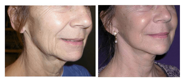 Patiente avant et après le lipolift. © Dr Mitz, tous droits réservés Patiente avant et après le lipolift. © Dr Mitz, tous droits réservés