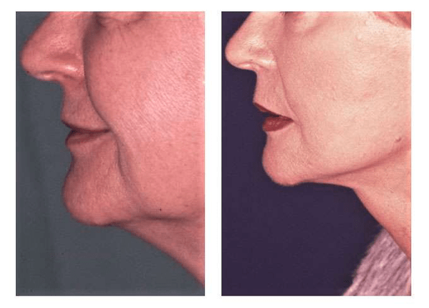Patiente avant et après un lifting cervico-facial. © Dr Mitz, tous droits réservés Patiente avant et après un lifting cervico-facial. © Dr Mitz, tous droits réservés