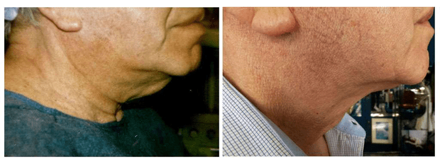 Aspect préopératoire de profil d'un patient avec cervico-plastie et, à droite, résultat post opératoire après 6 mois. © Dr Mitz, tous droits réservés Aspect préopératoire de profil d'un patient avec cervico-plastie et, à droite, résultat post opératoire après 6 mois. © Dr Mitz, tous droits réservés