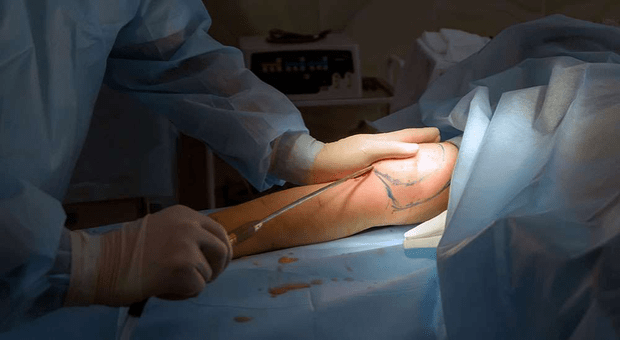 Liposuccion du bourrelet graisseux. © Vital, Adobe Stock