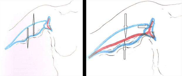 À gauche dessin de la brachioplastie du bras en T, et à droite cicatrice finale en T. © Dr Mitz, tous droits réservés