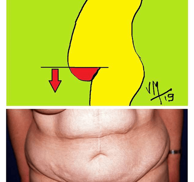 Le ventre en besace ou tablier abdominal