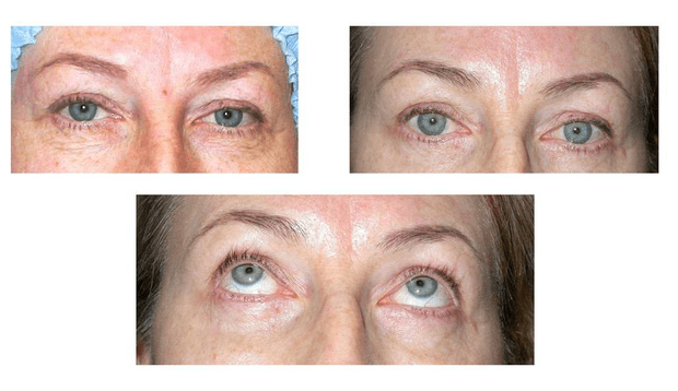 1/ Paupières inférieures flétries - 2/ Même patiente après blépharoplastie en retendant le muscle orbiculaire - 3/ Même patiente après, le regard vers le haut. © Dr Mitz, tous droits réservés