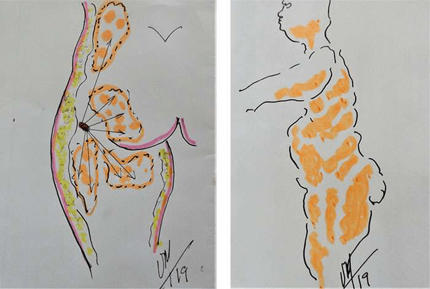 Illustration des répartitions différentes en profondeur des graisses superposées, superficielles et profondes. © Dr Mitz, tous droits réservés