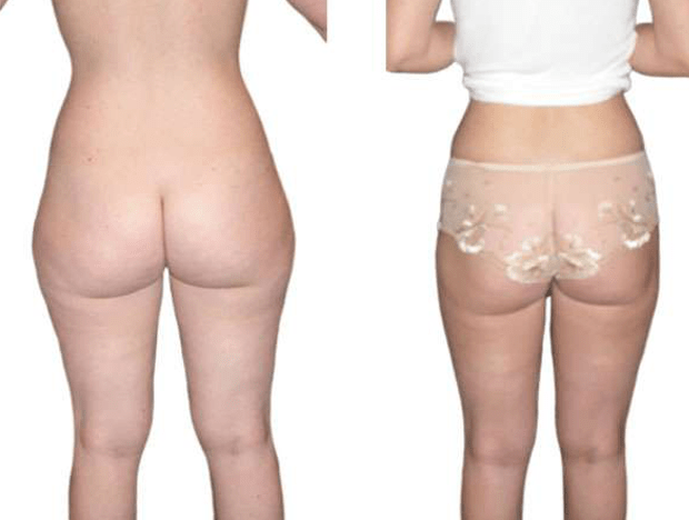 Liposuccion des parties inférieures. © Dr Mitz, tous droits réservés