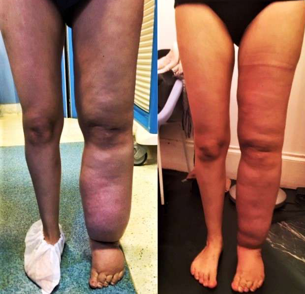 Résultat à 6 mois après un seul temps de lympho-liposuccion pour lymphœdème chronique. © Dr Mitz, tous droits réservés