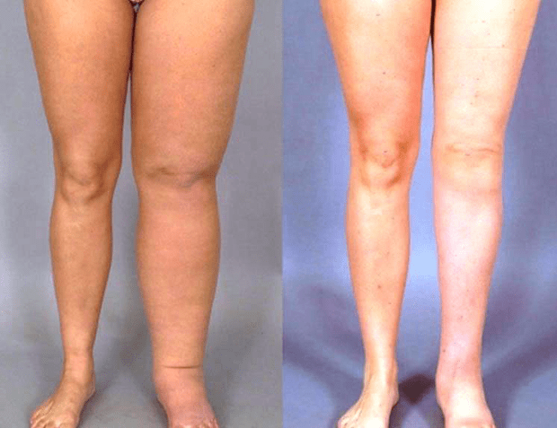 Résultat au bout d'1 an après traitement microchirurgical d'un lymphœdème unilatéral. © Dr Mitz, tous droits réservés 