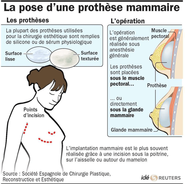 On estime à environ 500.000 le nombre de Françaises ayant subi une opération de chirurgie pour se faire poser un implant mammaire. Cette illustration explique les procédés utilisés. © Idé 