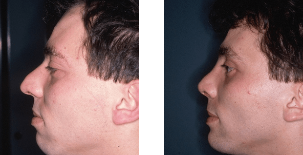 Comparaison avant et après rhinoplastie
