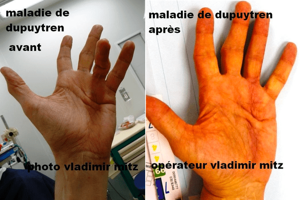 Avant / Après maladie de Dupuytren