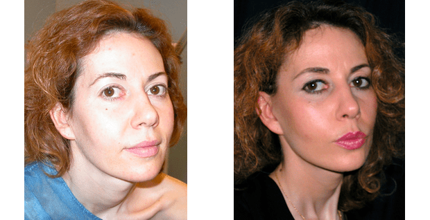 Lifting cervico-facial, avant /après