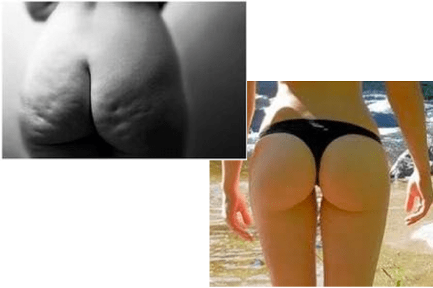 Cellulite
