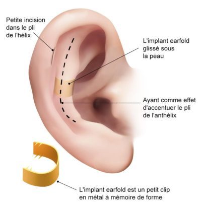 Ear fold implant