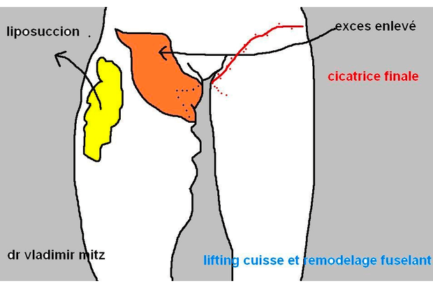 Schéma cicatrices, liposuccion et lifting cuisses et remodelage fuselant