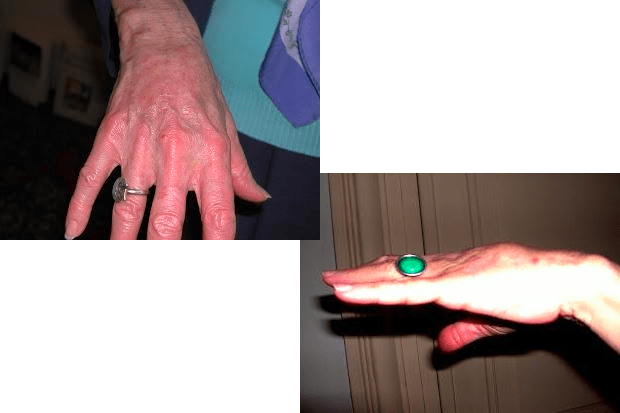 Greffe de graisse sur une main parcheminée