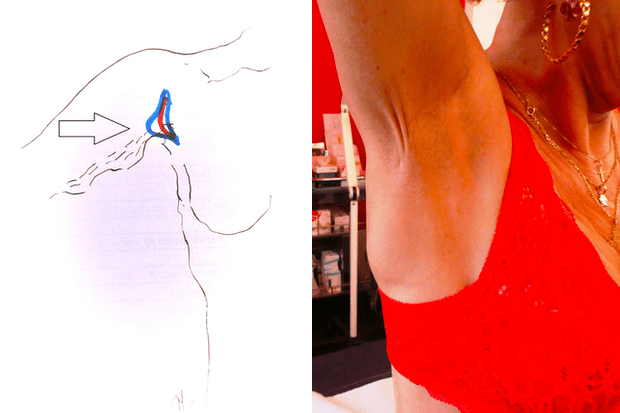 brachioplastie axillaire