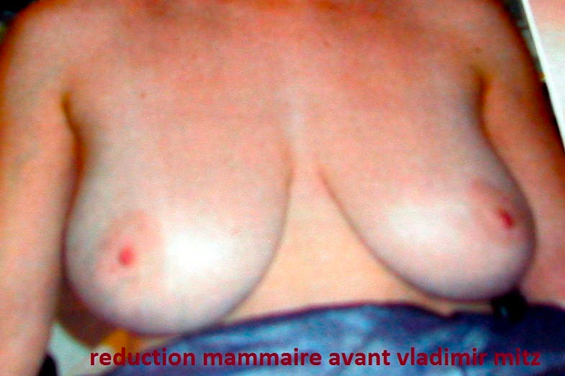 Patiente avant réduction mammaire