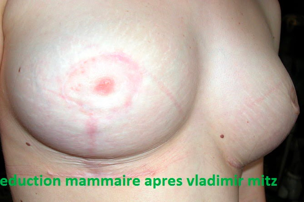 Réduction mammaire après opération