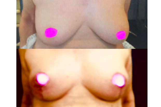 lifting du sein avec cicatrice verticale pure