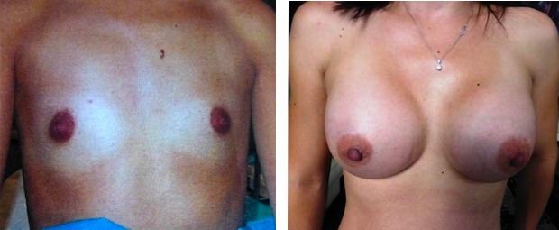 augmentation mammaire par implants de 350cc