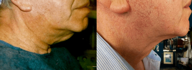 Avant/Après lifting cou