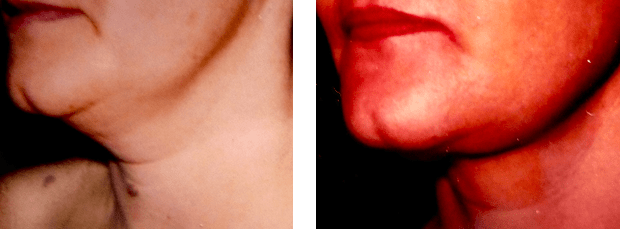 Avant/Après lifting cervico-Facial