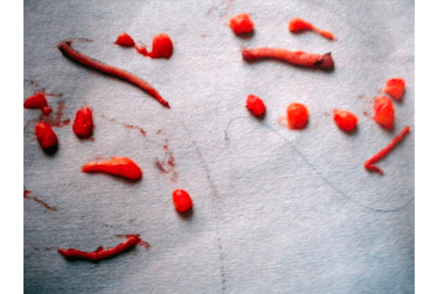 Excédent de graisse retiré