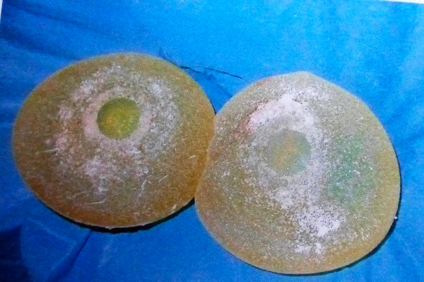 Calcifications autour des implants mammaires retirés 25 ans après introduction