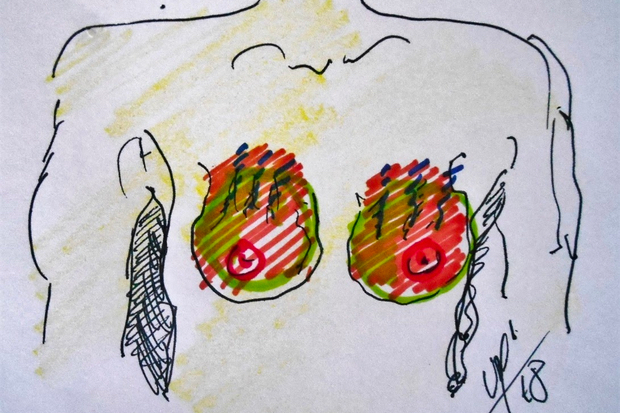 Vagues autour du pôle supérieur des prothèses mammaires