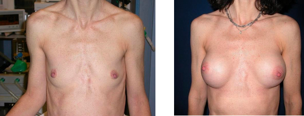 Patiente aux seins très écartés, avec des prothèses latéralisées de 200cc, En position rétromusculaire