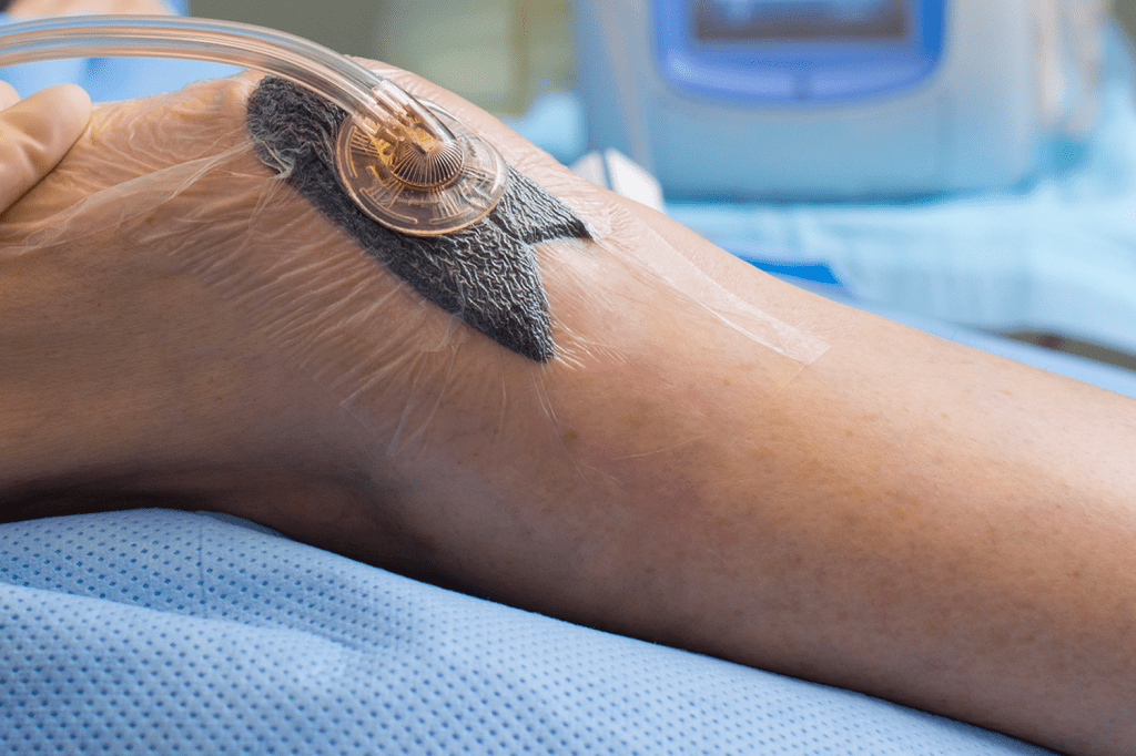 Le V.A.C. ou vacuum assisted closure system